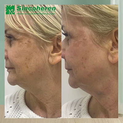 4D HIFU facial y corporal para levantar la piel y perder grasa - Foto 2