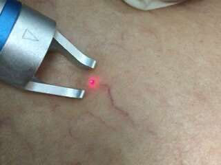 980nm Diodo Laser remoção da veia da aranha,remoção vascular - Foto 3