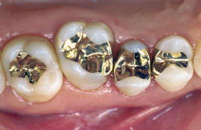 Alliages dentaires precieux energy - Photo 2