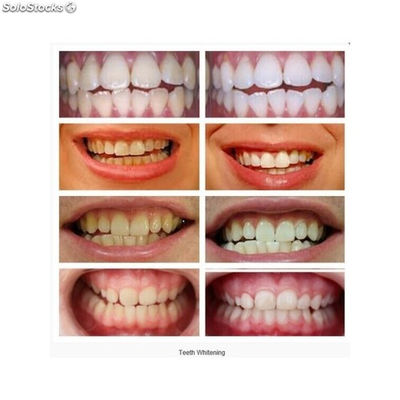 Blanqueamiento dental econ white - Foto 5