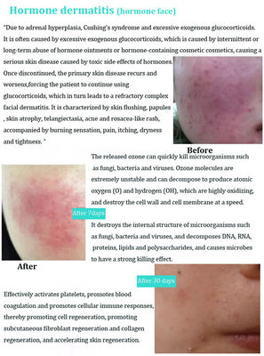 Caneta de ozônio plasma para rejuvenescimento da pele e tratamento da acne - Foto 4