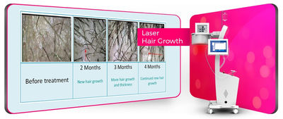 Capilar de diodo para tratar pérdida de pelo y cabello - Foto 2