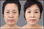 Equipamento de levantamento facial HIFU 3D - Foto 2