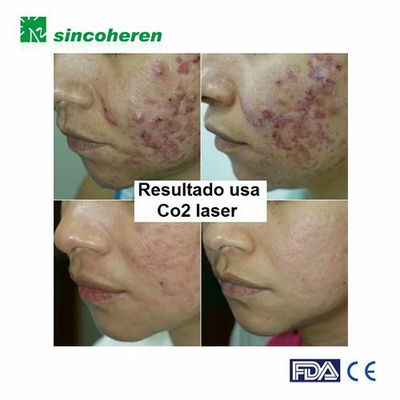 Equipo laser co2 fraccionado para eliminar cicatriz acne tratamiento vaginal - Foto 4