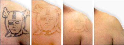 Estacionário Nd Yag Laser máquina de remoção de tatuagem com preço de fábrica - Foto 3
