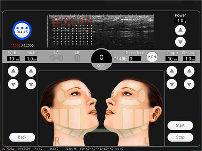 Hifu 3D rejuvnecimiento facial y corporal 8 cartuchos - Foto 5