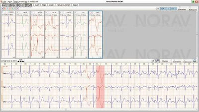 Holter ECG 3 canales 24 / 48 horas /7 dias NH301