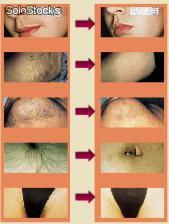 Ipl, rf , cabelo , acne, remoção da pigmentação , rejuvenescimento , depilaçao - Foto 2