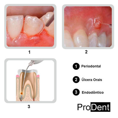 Laser Odontológico Diode - Foto 3