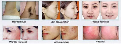 Máquina de depilación IPL portátil Terapia de acné Eliminación de arrugas - Foto 4