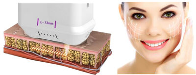 Máquina multifuncional de depilación para rejuvenecimiento de la piel con láser - Foto 4
