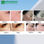Micro needle facial,radio frecuencia fraccionada para cicatrices de acne,para - Foto 5
