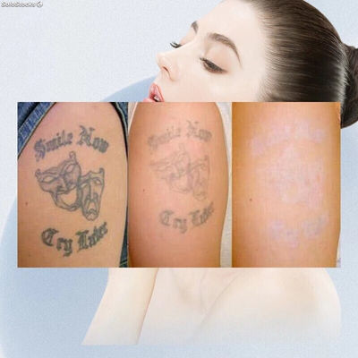 mini nd yag laser para tatuajes , peca , mancha , omicomicosis , rejuvenecer - Foto 3