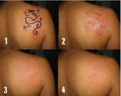 Nd yag laser eliminar de tatuajes - Foto 3