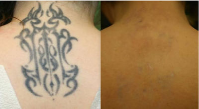 Picolaser para eliminación de tatuajes/peca/rejuvenecimiento de piel - Foto 4
