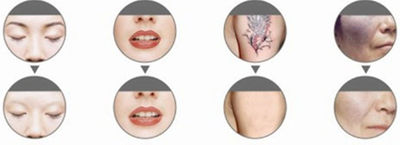 Picosecond Laser pour enlever les tatouages et rajeunir la peau - Photo 2