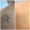 Picosegundo Laser para remover tatuagens e rejuvenescer pele - Foto 2