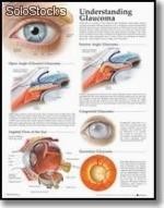 Plansza 3D Understanding Glaucoma