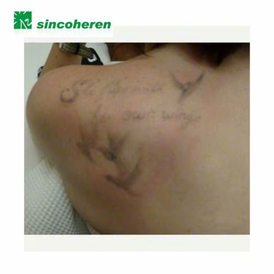 Q-Switch nd yag laser para onicomiconisis hongos eliminar tatuaje peca mancha - Foto 5