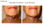 Radiofrecuencia rejuvenecimiento anti-arrugas cosmetica belleza - Foto 3