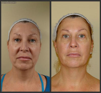 Radiofrecuencia y rejuvenecimiento anti-arrugas cosmetica belleza - Foto 2