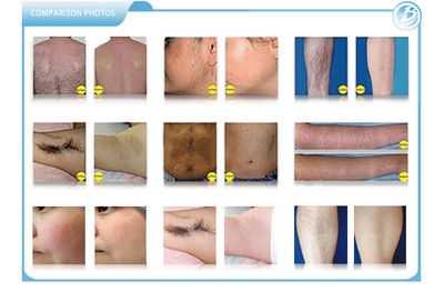 Rejuvenecimiento de la piel de la máquina de depilación láser IPL SHR - Foto 5