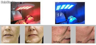 Rejuvenecimiento LED/PDT para piel - Foto 3