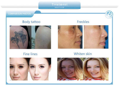 Tattoo Removal Machine Super Picosecond Laser Beauty Equipment - Foto 3