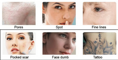 Tattoo Removal Machine Super Picosecond Laser Beauty Equipment - Foto 5