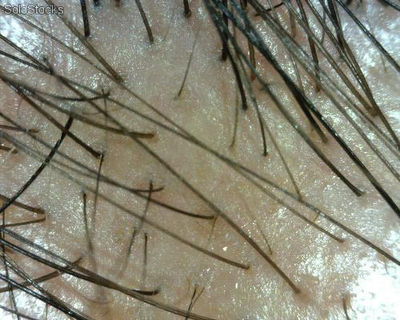 Tricoscopio de dino-lite para estudio capilar y cuero cabelludo - Foto 2