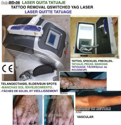 yag laser , Rimuove tatuaggio, trucco permanente, telangectiasis
